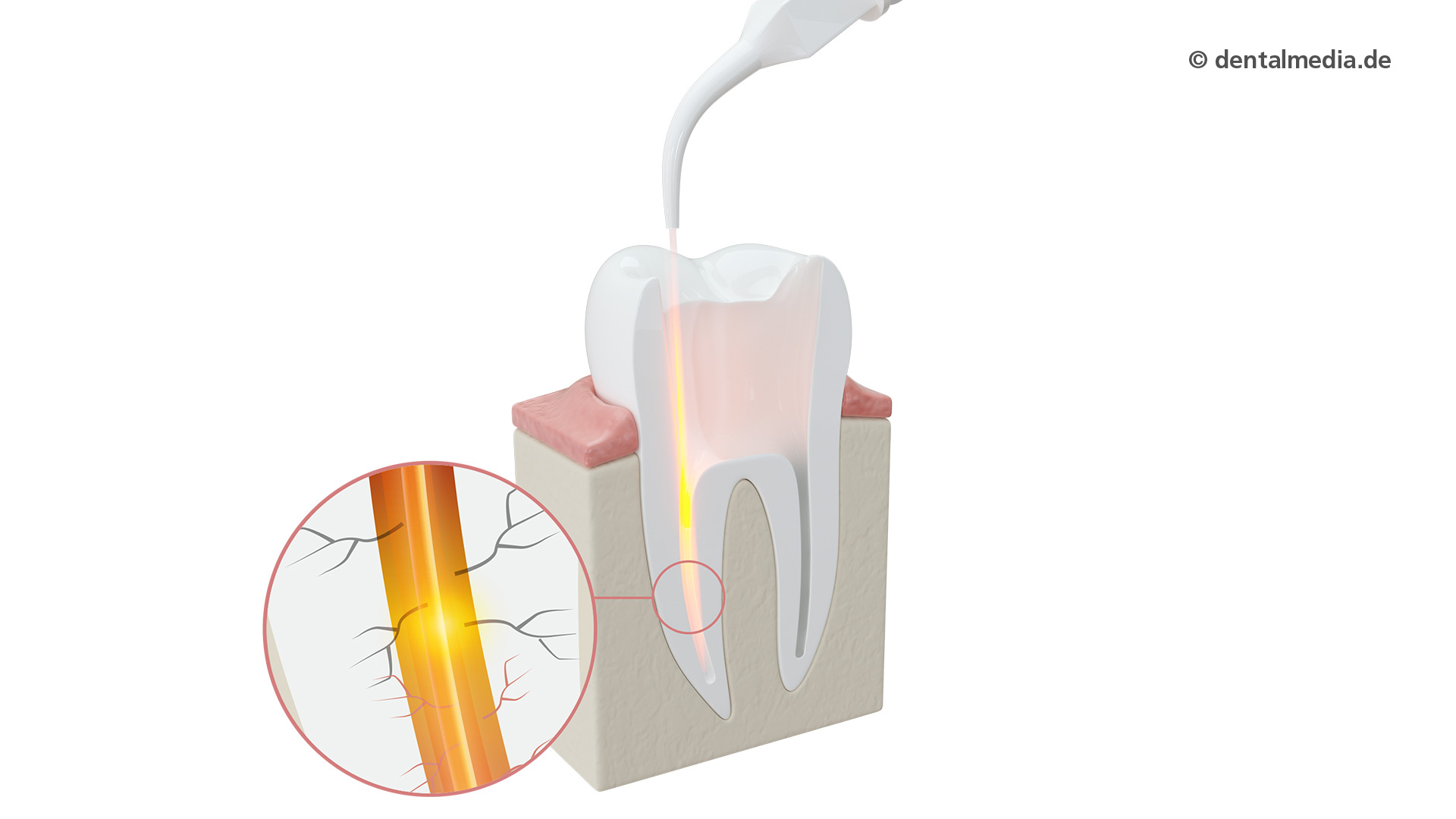 Laserzahnheilkunde in Ihrer Zahnarztpraxis in Münster