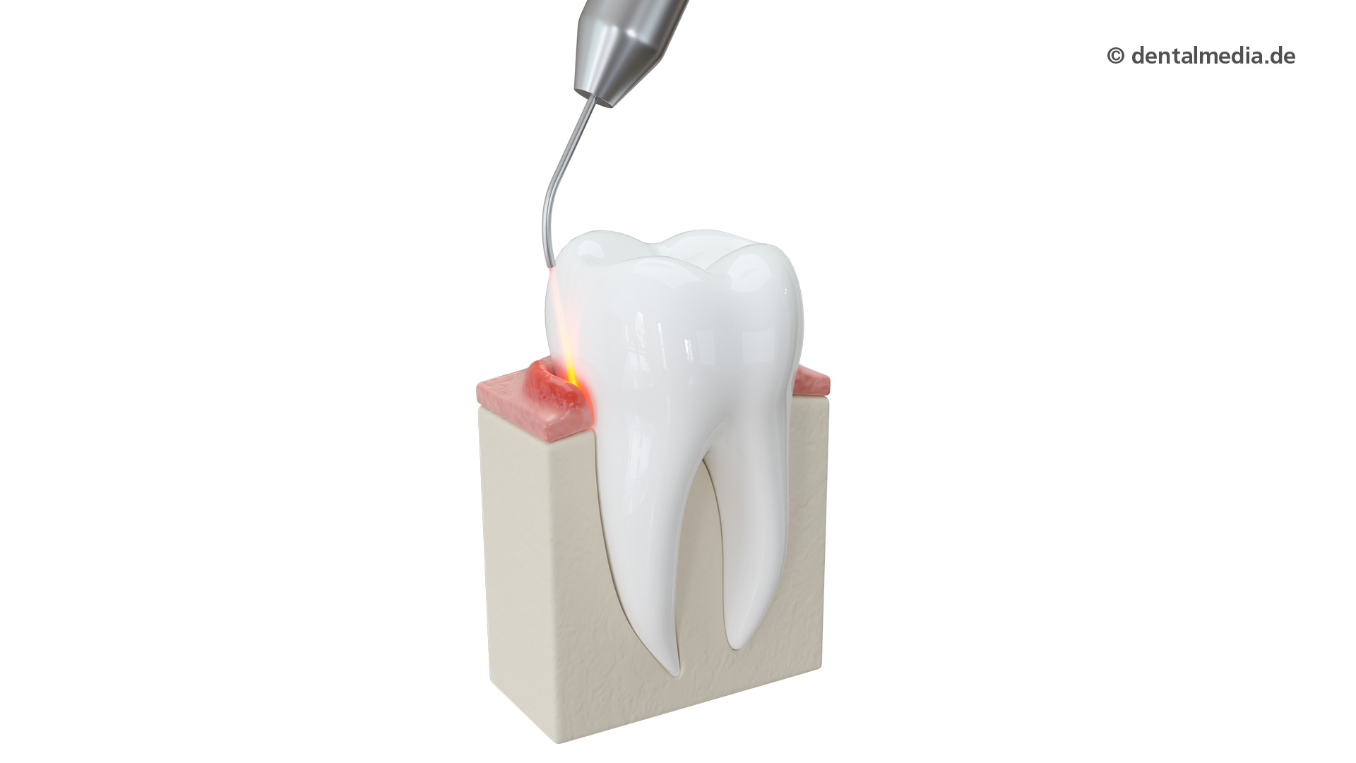 Laserzahnheilkunde bei Ihrem Zahnarzt in Münster